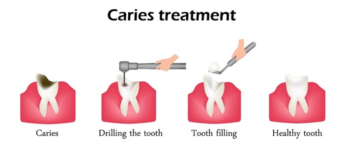 Cavity filled getting dental tooth hole small fillings when enamel