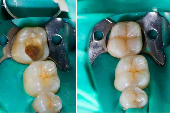 Fillings cavity filling tooth